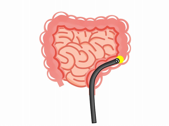 大腸カメラで（大腸内視鏡検査）で発見可能な病気